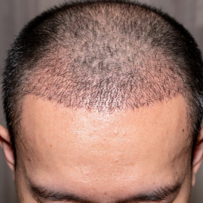 Hair Transplant – Types, Benefits, and Tips to Choose a Doctor