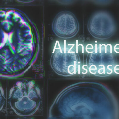 10 Early Signs of Alzheimer’s Disease