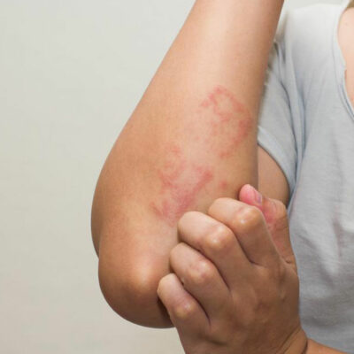 Eczema – Types, Causes, Symptoms, and Treatment