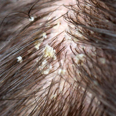 Get Rid of Dry Scalp with Nature’s Care