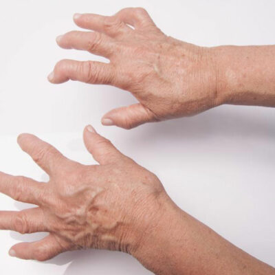 Here’s What You Need to Know About Rheumatoid Arthritis Symptoms