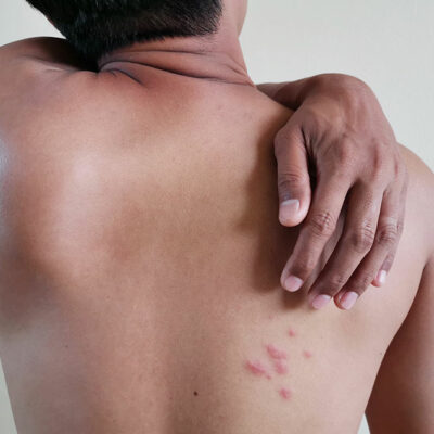 Shingles – Treatment options and preventive measures